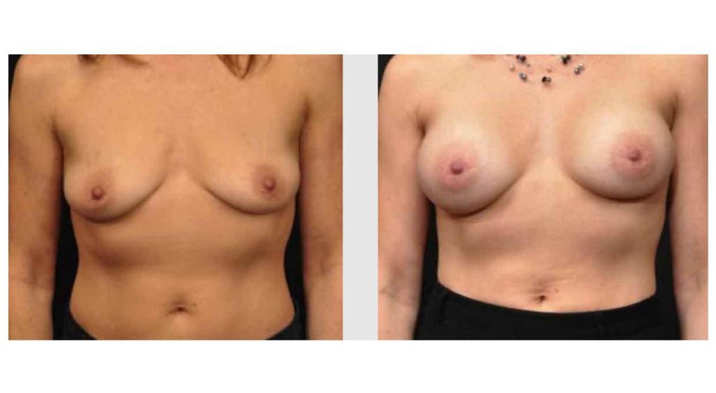 A Before and After photo of a Breast Augmentation Plastic Surgery by Dr. Craig Jonov in Seattle and Tacoma
