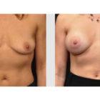 A Before and After photo of a Breast Augmentation Plastic Surgery by Dr. Craig Jonov in Seattle and Tacoma