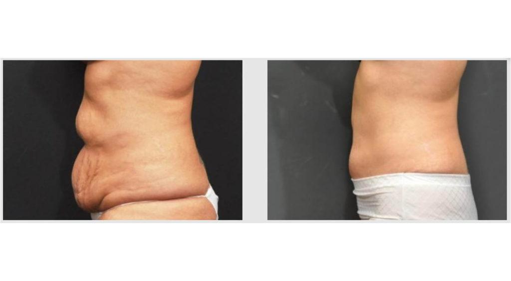 A Before and After photo of a Tummy Tuck Plastic Surgery by Dr. Craig Jonov in Seattle and Tacoma