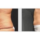 A Before and After photo of a Tummy Tuck Plastic Surgery by Dr. Craig Jonov in Seattle and Tacoma