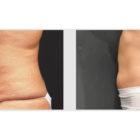 A Before and After photo of a Tummy Tuck Plastic Surgery by Dr. Craig Jonov in Seattle and Tacoma