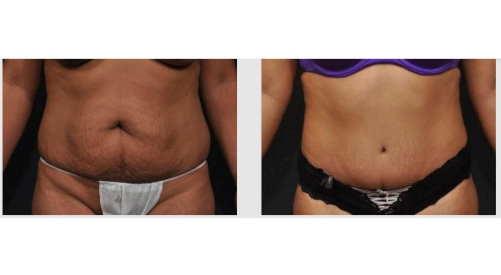 A Before and After photo of a Tummy Tuck Plastic Surgery by Dr. Craig Jonov in Seattle and Tacoma