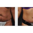 A Before and After photo of a Tummy Tuck Plastic Surgery by Dr. Craig Jonov in Seattle and Tacoma