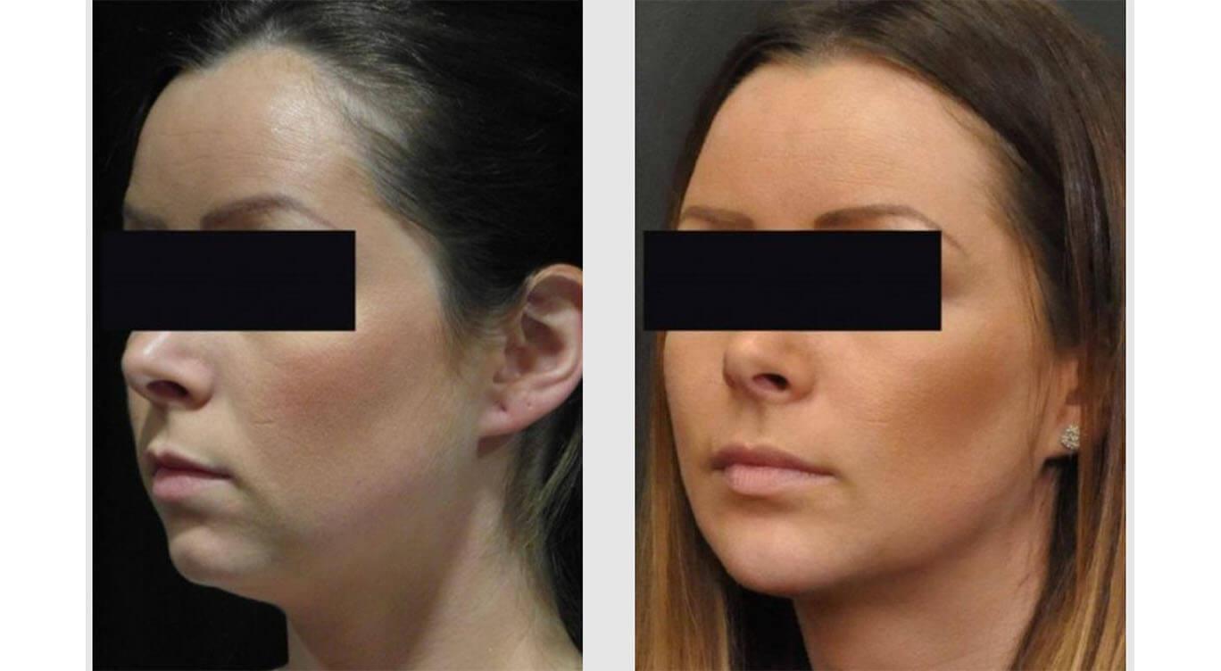 A Before and After photo of a Liposuction Plastic Surgery by Dr. Craig Jonov in Seattle and Tacoma