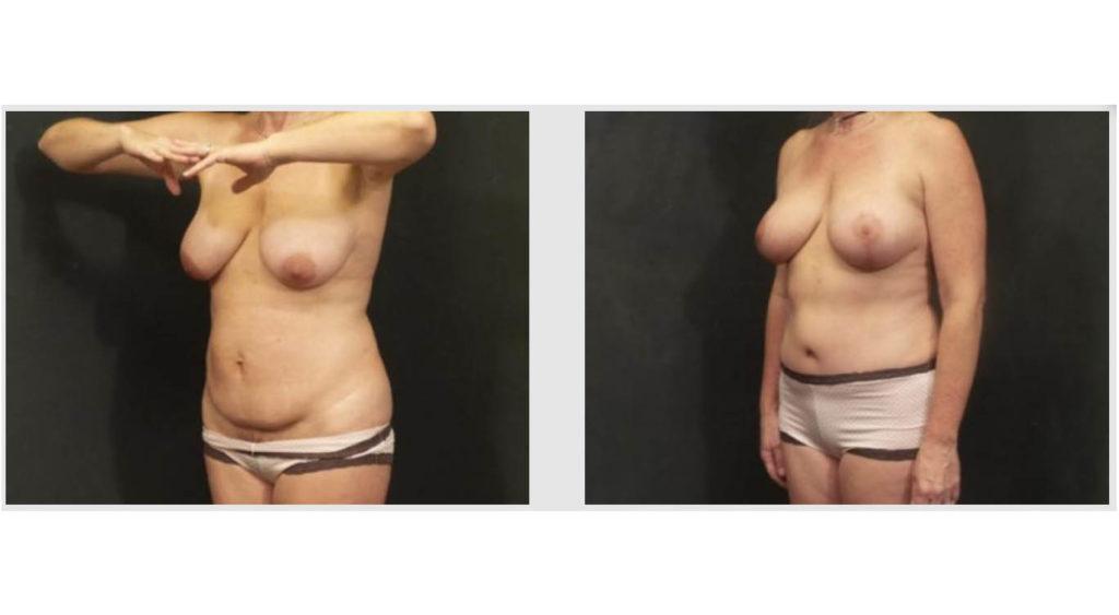 A Before and After photo of a Tummy Tuck Plastic Surgery by Dr. Craig Jonov in Seattle and Tacoma