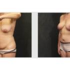 A Before and After photo of a Tummy Tuck Plastic Surgery by Dr. Craig Jonov in Seattle and Tacoma