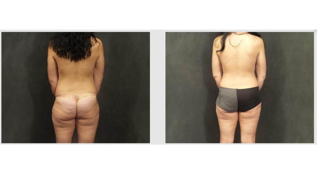 A Before and After photo of a Tummy Tuck Plastic Surgery by Dr. Craig Jonov in Seattle and Tacoma