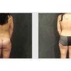 A Before and After photo of a Tummy Tuck Plastic Surgery by Dr. Craig Jonov in Seattle and Tacoma