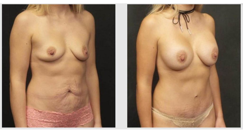 A Before and After photo of a Tummy Tuck Plastic Surgery by Dr. Craig Jonov in Seattle and Tacoma