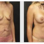 A Before and After photo of a Tummy Tuck Plastic Surgery by Dr. Craig Jonov in Seattle and Tacoma