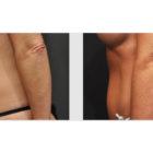 A Before and After photo of a Tummy Tuck Plastic Surgery by Dr. Craig Jonov in Seattle and Tacoma