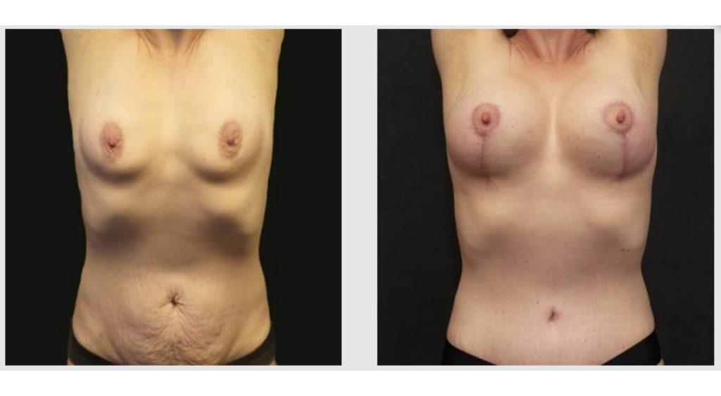 A Before and After photo of a Tummy Tuck Plastic Surgery by Dr. Craig Jonov in Seattle and Tacoma