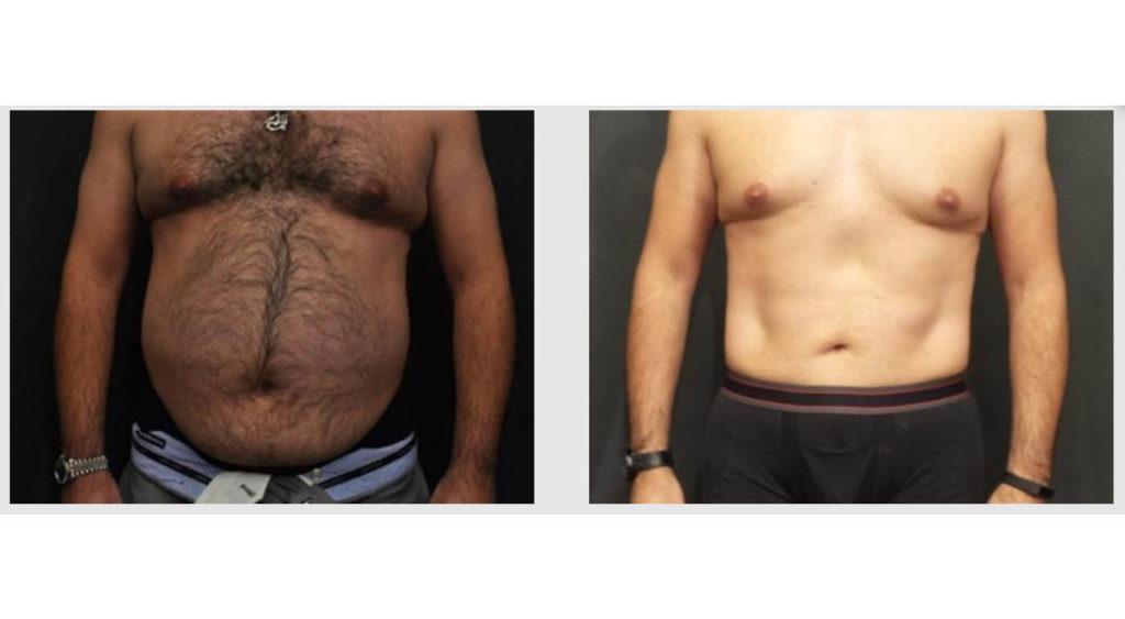 A Before and After photo of a Tummy Tuck Plastic Surgery by Dr. Craig Jonov in Seattle and Tacoma