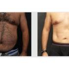 A Before and After photo of a Tummy Tuck Plastic Surgery by Dr. Craig Jonov in Seattle and Tacoma