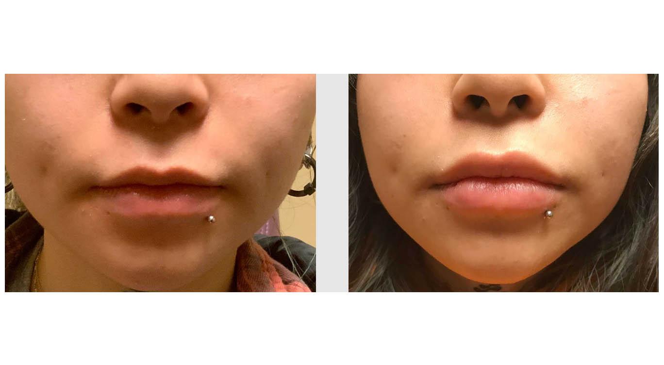 A Before and After photo of Juvederm Lip Filler at Seattle Plastic Surgery in Seattle and Tacoma