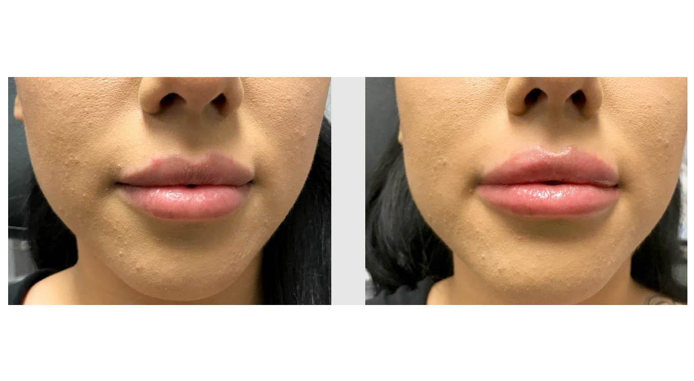 A Before and After photo of Juvederm Lip Filler at Seattle Plastic Surgery in Seattle and Tacoma