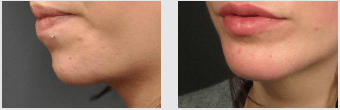 A Before and After photo of a Liposuction Plastic Surgery by Dr. Craig Jonov in Seattle and Tacoma