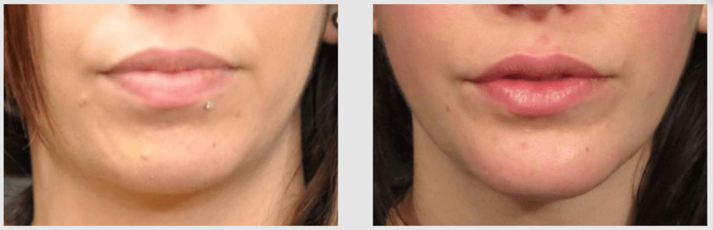 A Before and After photo of a Liposuction Plastic Surgery by Dr. Craig Jonov in Seattle and Tacoma