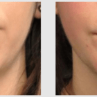 A Before and After photo of a Liposuction Plastic Surgery by Dr. Craig Jonov in Seattle and Tacoma