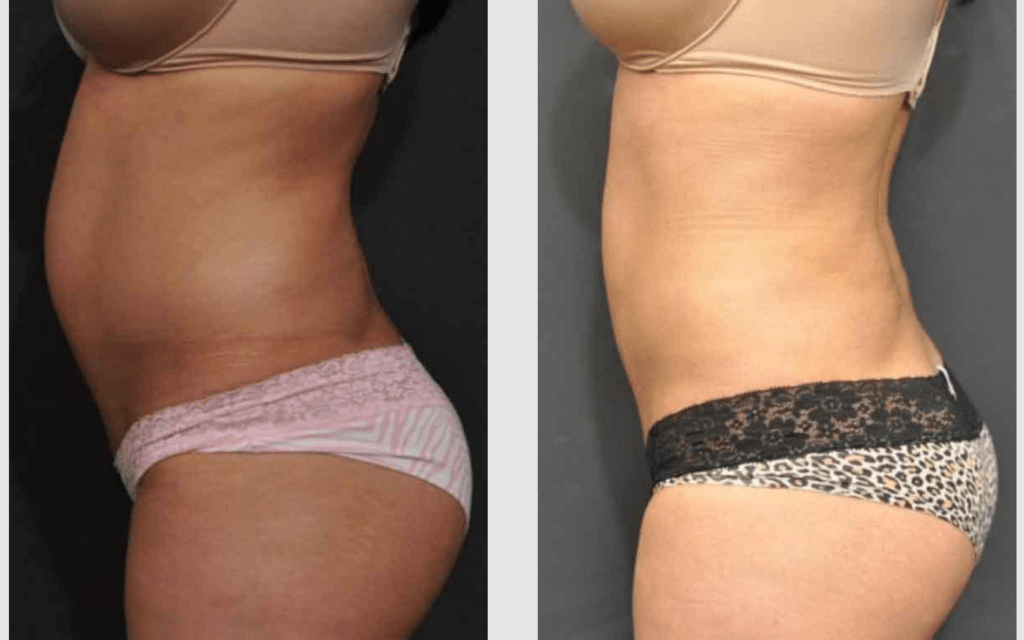A Before and After photo of a Liposuction Plastic Surgery by Dr. Craig Jonov in Seattle and Tacoma