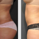 A Before and After photo of a Liposuction Plastic Surgery by Dr. Craig Jonov in Seattle and Tacoma