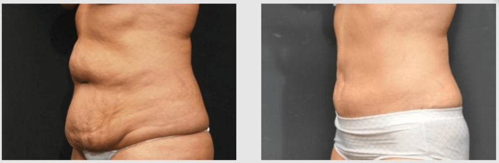 A Before and After photo of a Liposuction Plastic Surgery by Dr. Craig Jonov in Seattle and Tacoma