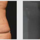 A Before and After photo of a Liposuction Plastic Surgery by Dr. Craig Jonov in Seattle and Tacoma