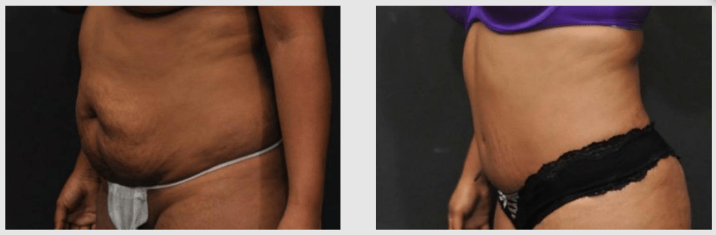 A Before and After photo of a Liposuction Plastic Surgery by Dr. Craig Jonov in Seattle and Tacoma