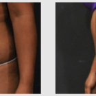 A Before and After photo of a Liposuction Plastic Surgery by Dr. Craig Jonov in Seattle and Tacoma