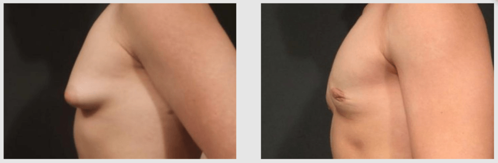 A Before and After photo of a Liposuction Plastic Surgery by Dr. Craig Jonov in Seattle and Tacoma
