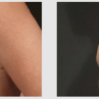 A Before and After photo of a Liposuction Plastic Surgery by Dr. Craig Jonov in Seattle and Tacoma