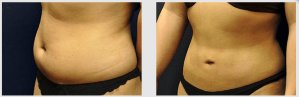 A Before and After photo of a Liposuction Plastic Surgery by Dr. Craig Jonov in Seattle and Tacoma