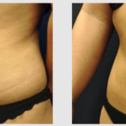 A Before and After photo of a Liposuction Plastic Surgery by Dr. Craig Jonov in Seattle and Tacoma