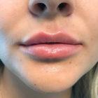 An After Photo of Lip Fillers in Seattle and Tacoma