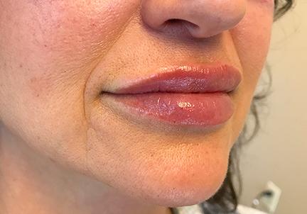 An After Photo of Lip Filler in Seattle and Tacoma