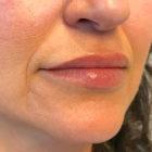 A Before Photo of Lip Filler in Seattle and Tacoma