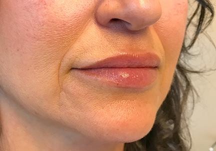 A Before Photo of Lip Filler in Seattle and Tacoma