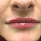 An After Photo of Lip Filler in Seattle and Tacoma