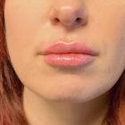 An After Photo of Restylane L Lip Filler in Seattle and Tacoma