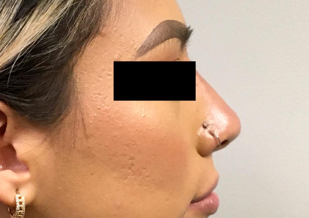 An After Photo of a Non-Surgical Rhinoplasty by Dr. Craig Jonov in Seattle and Tacoma