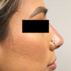 An After Photo of a Non-Surgical Rhinoplasty by Dr. Craig Jonov in Seattle and Tacoma
