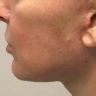 An After Photo of a Mini Facelift Plastic Surgery in Seattle and Tacoma