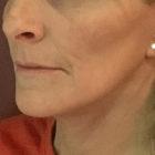An After Photo of a Mini Facelift Plastic Surgery by Dr. David Santos in Seattle and Tacoma