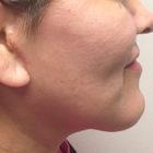 An After Photo of a Mini Facelift Plastic Surgery by Dr. David Santos in Seattle and Tacoma