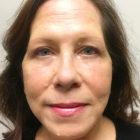 An After Photo of a CO2 Laser Resurfacing Plastic Surgery by Dr. David Santos in Seattle and Tacoma