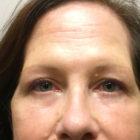 An After Photo of a Lower Blepharoplasty Plastic Surgery by Dr. David Santos in Seattle and Tacoma