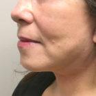 An After Photo of a Facelift Plastic Surgery by Dr. David Santos in Seattle and Tacoma