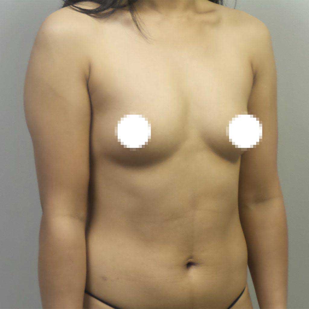 A Before Photo of a Breast Augmentation Plastic Surgery by Dr. Craig Jonov in Seattle and Tacoma