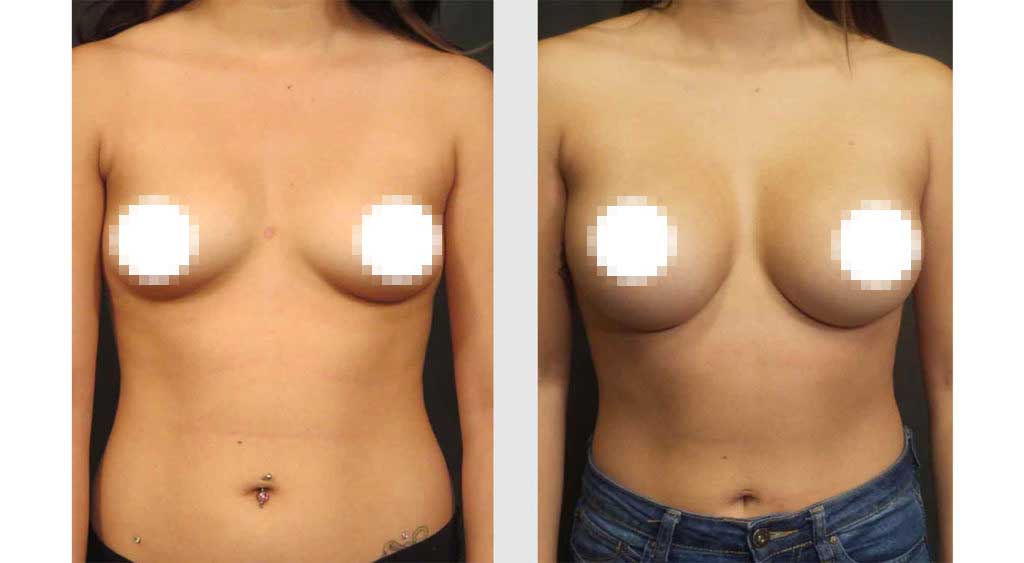 A Before and After of a Breast Augmentation Plastic Surgery by Dr. Craig Jonov in Seattle and Tacoma