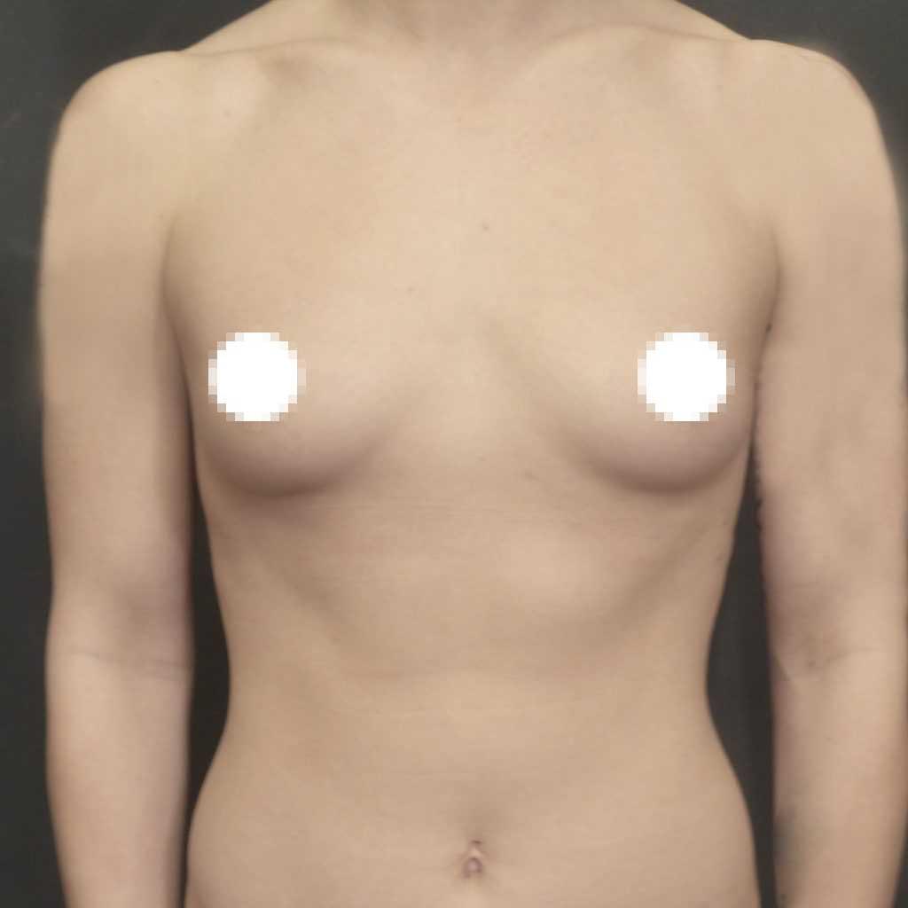 A Before Photo of a Breast Augmentation Plastic Surgery by Dr. Craig Jonov in Seattle and Tacoma